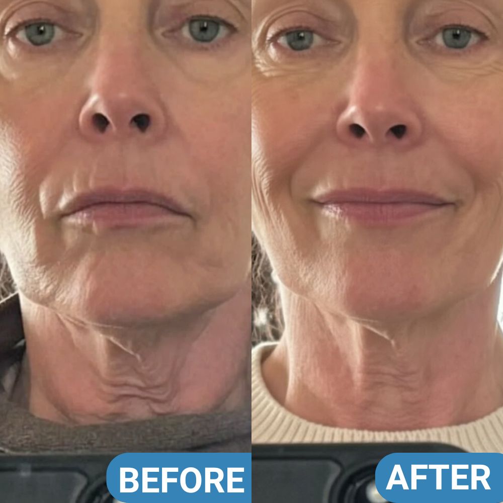 NeckProtocol Tight & Lift